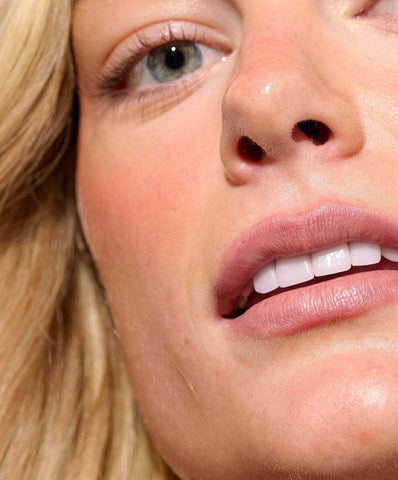 What is Perioral Dermatitis?