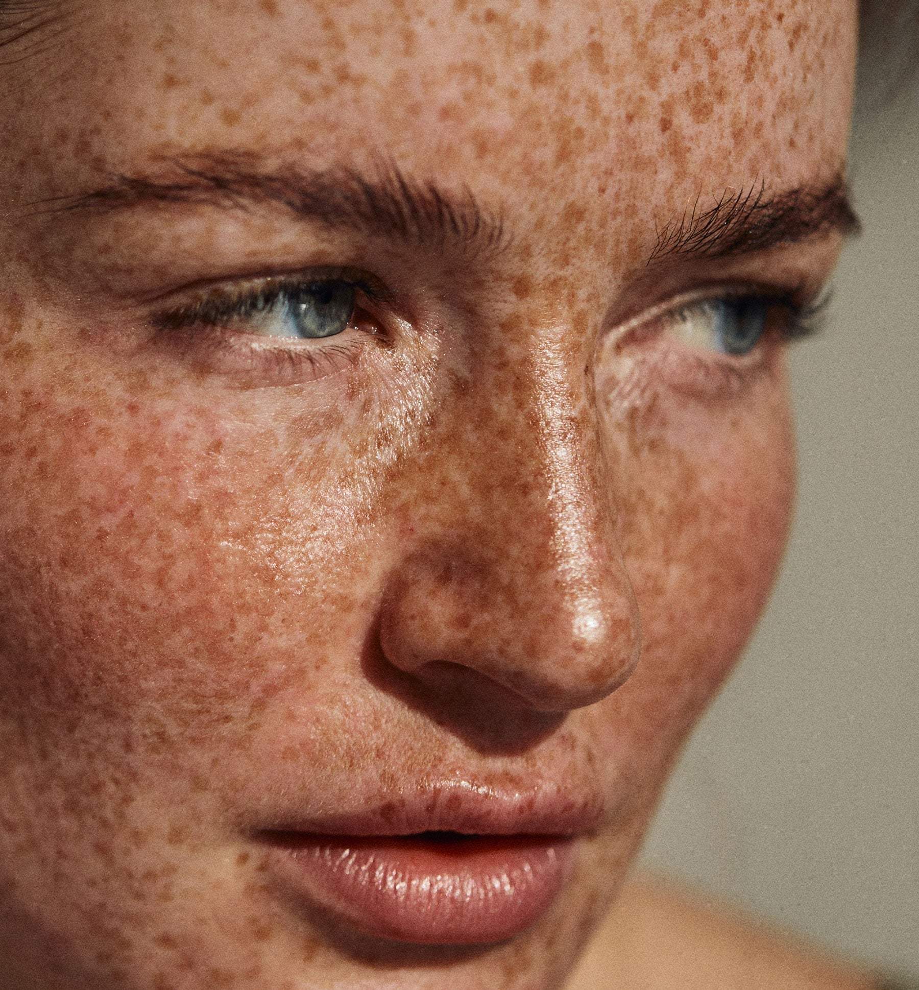Hyperpigmentation Treatments 101: How Phloretin and Niacinamide Help