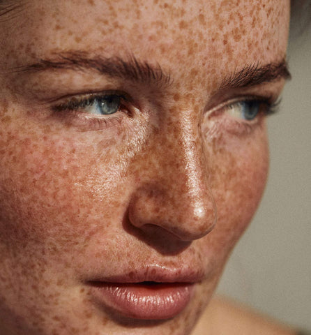 Hyperpigmentation Treatments 101: How Phloretin and Niacinamide Help